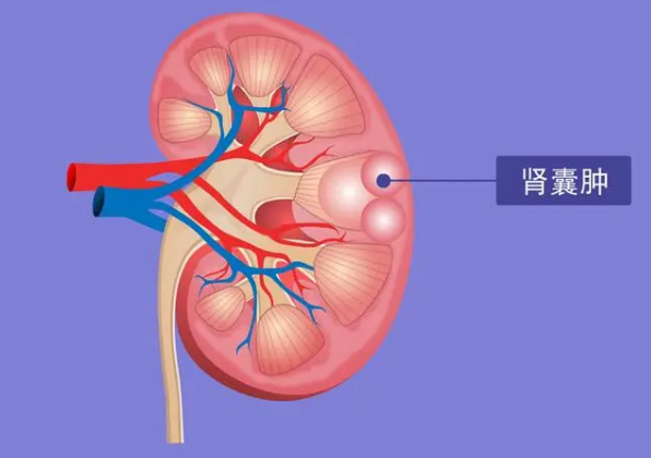 其次肾脏也不能无限制的扩大,随着囊肿的发展会引发腹痛,腰痛等症状