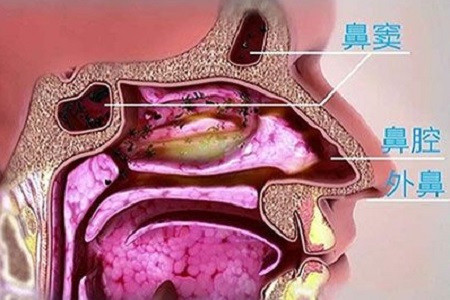 儿童鼻窦炎症状隐蔽要留心观察及时诊治