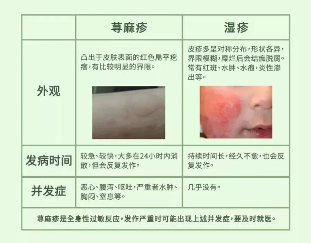 荨麻疹和湿疹都是生活中比较常见的两种过敏性皮肤病,症状非常相似