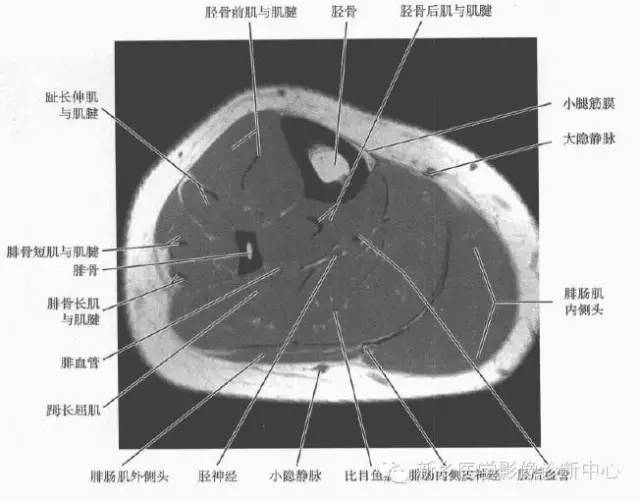 小腿部断层解剖详细标注