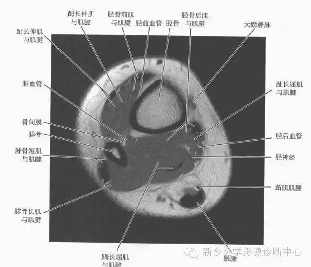 小腿部断层解剖详细标注