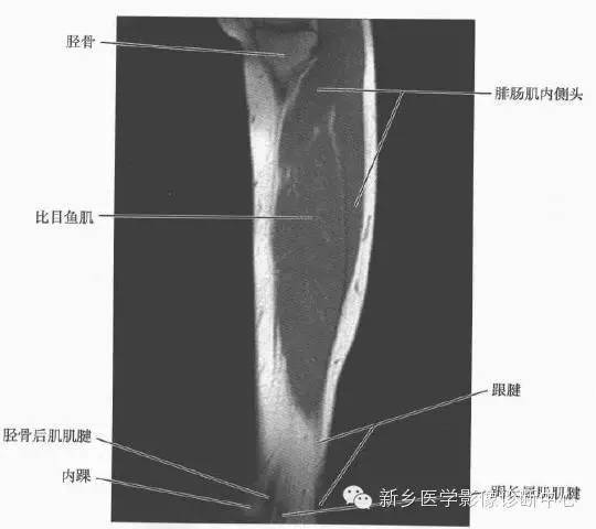 小腿部断层解剖详细标注