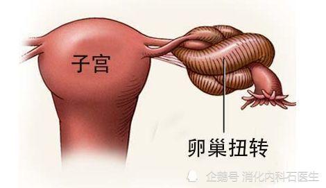 常见原因有(1)先天性异常:年幼儿童输卵管或输卵管系膜过长而易造成