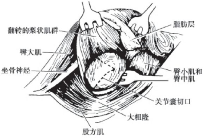 骨科小技巧髋关节后外侧gibson入路