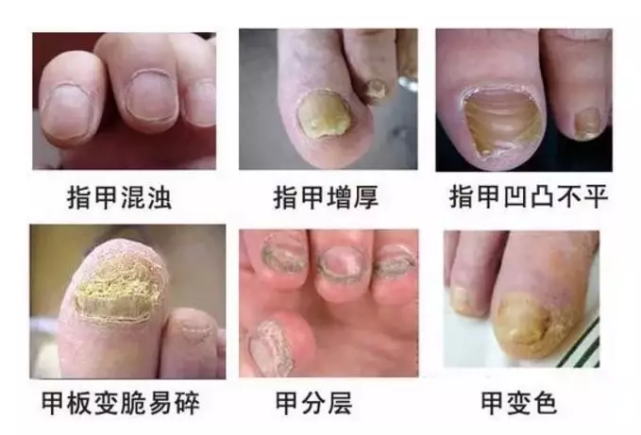 灰指甲又丑又尴尬,一个传染俩!每天2滴,长出健康新甲!