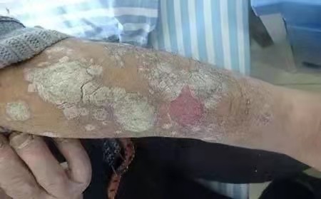 银屑病常见的几大类型是什么