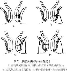 肛门小溃口谨防肛瘘,手术根除为上策!