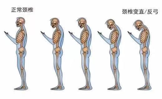 颈椎"生理曲度变直"是什么意思?还能恢复吗?