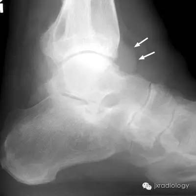 infectious arthritis感染性关节炎synovitis滑膜炎rheumatoid