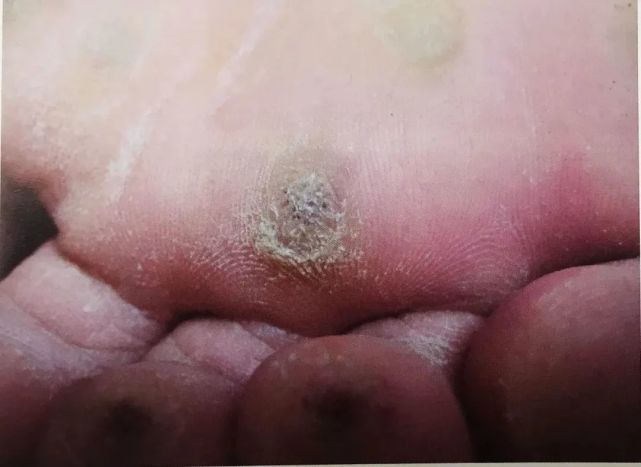 不懂就问:脚上长的这种像鸡眼的疙瘩是什么?