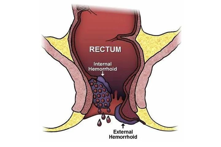 发现他有很严重的混合痔,其中右前方外痔伴有血栓形成,左后方的内痔
