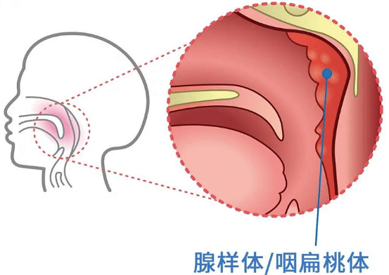 儿童腺样体肥大各位宝妈们是手术切除还是保守治疗呢