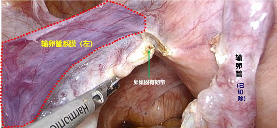 对于输卵管系膜血管的凝固,大家需要格外注意,因为该处血管迂曲且较粗