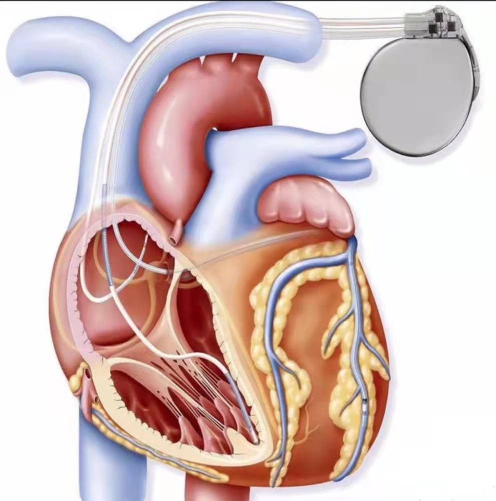 大学咸阳医院心血管内科三病区成功独立完成虎年首例三腔起搏器植入术