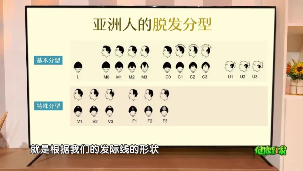 最后可能变成最为严重的u型脱发;亚洲人脱发分型2斑秃休止期脱发雄秃