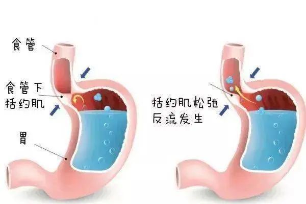 当我们吃东西的时候,食管下括约肌会舒张放松,当食物进入胃里时,就会