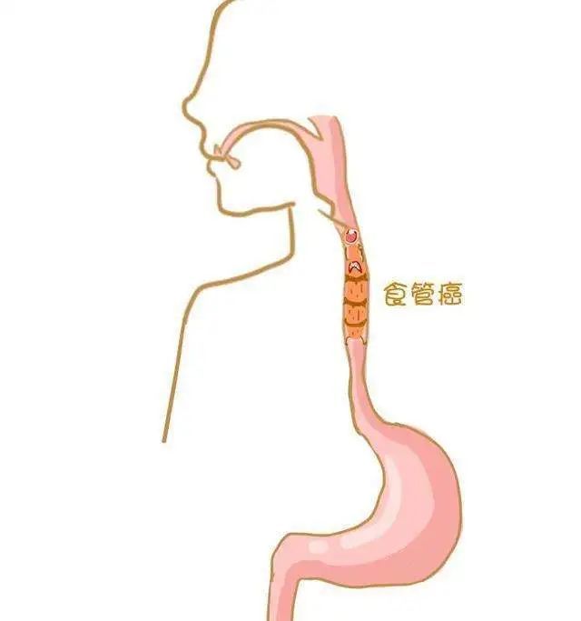 癌症康复丨食道重生食管癌术后患者的护理