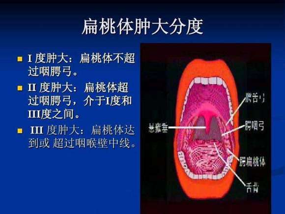 频繁发作的扁桃体炎,或者扁桃体病变全面影响儿童健康或使儿童中断