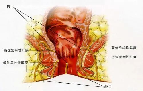 真有人因为肛门疼痛致命这5类肛门疼痛要警惕