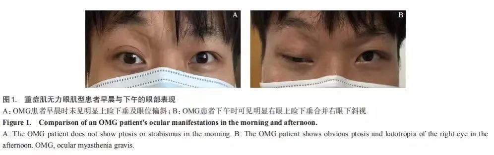 眼睛总是睁不开别忽视小心重症肌无力找上门