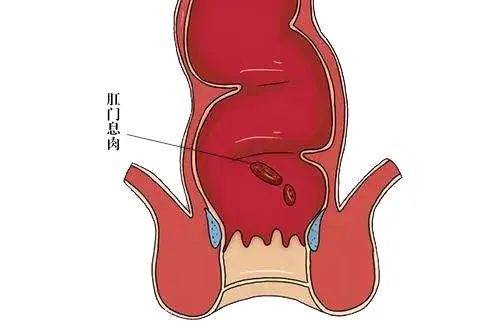 肛门息肉是啥长什么样子