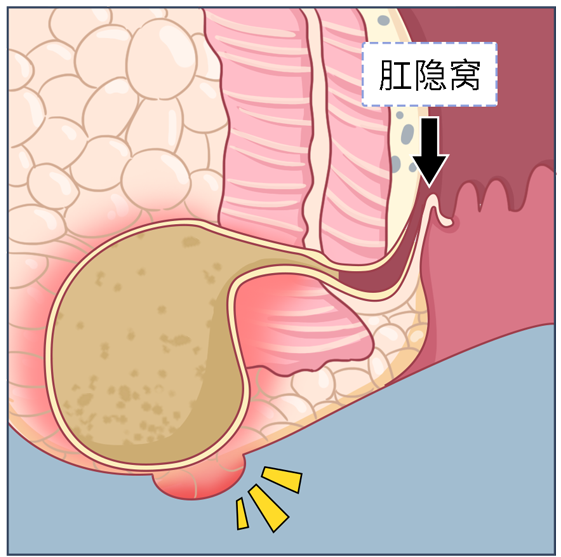 肛窦炎多种肛门不适的元凶