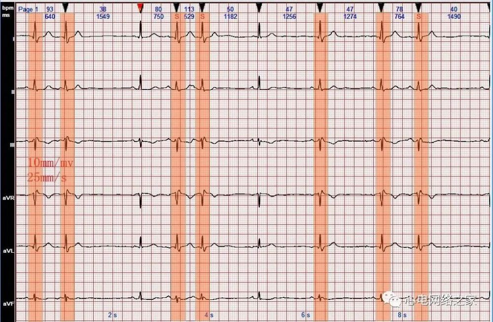 心电图病例分析66间歇性完全性右束支阻滞