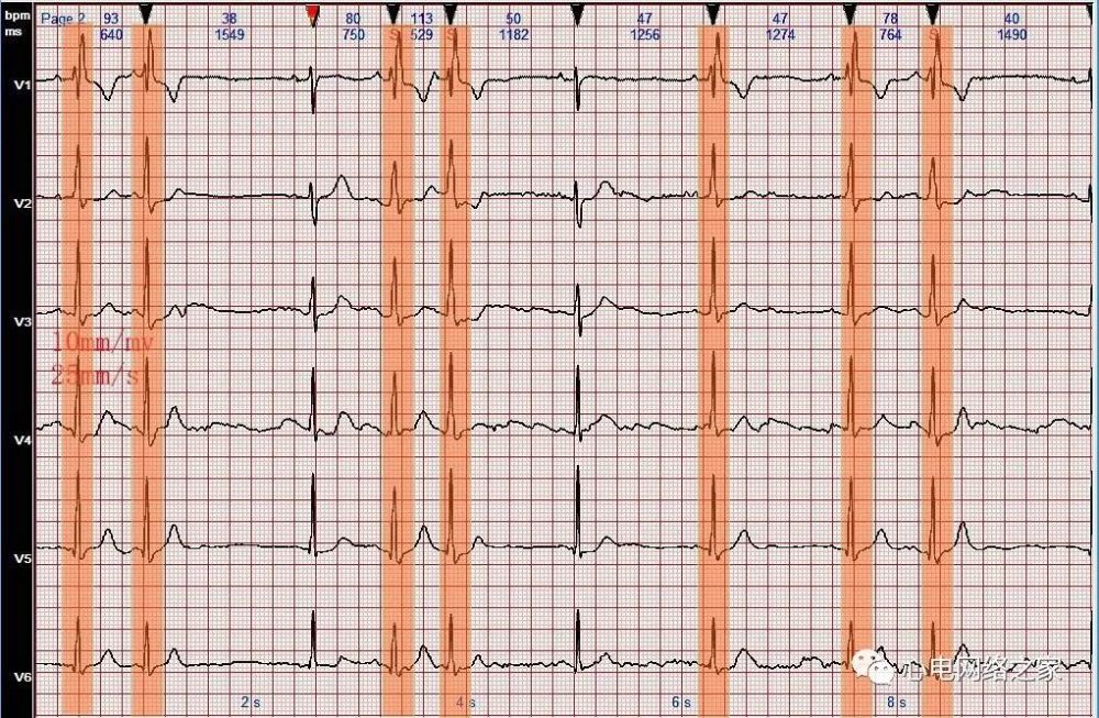 心电图病例分析66间歇性完全性右束支阻滞