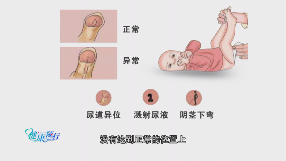 健康随行小隐成大患尿道下裂