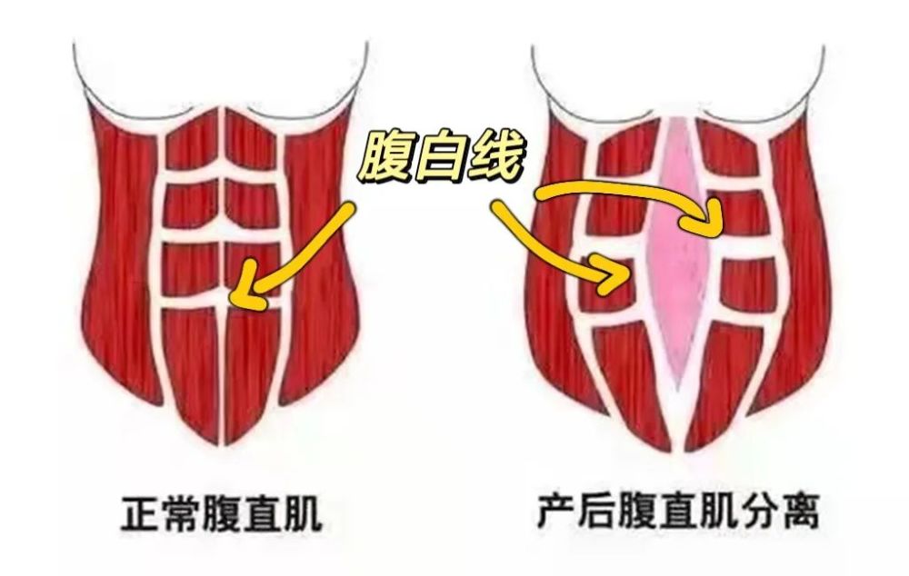 或肥胖等因素可能导致腹白线组织受到机械压力,进而发生腹直肌分离