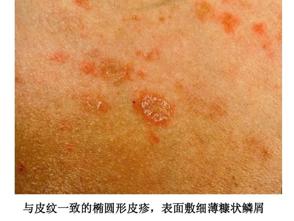 患上玫瑰糠疹怎么办