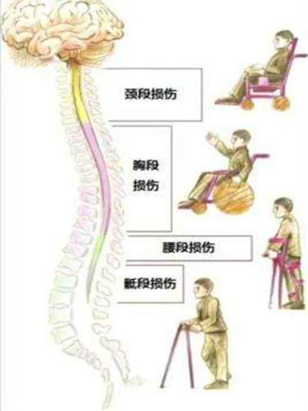 前方高能这个小工具竟让脊髓损伤患者可以自己吃饭了