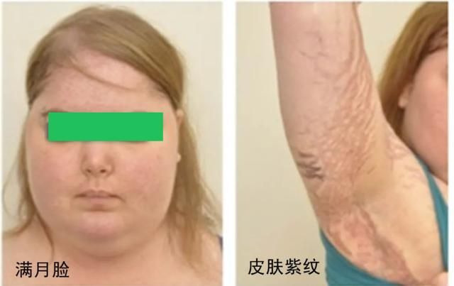 因长期使用糖皮质激素引起脂代谢和水盐代谢紊乱所致,表现为满月脸