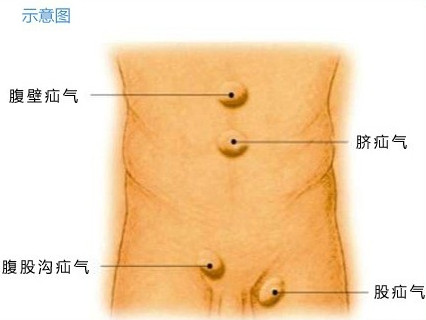 育儿知识关于小儿疝气家长最关心的几个问题