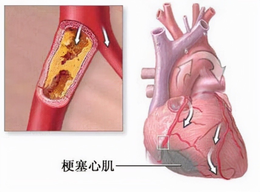 胃痛10多年最后一次发作竟是急性心梗下壁心肌缺血最会这么装