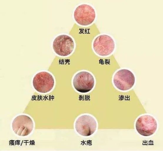 炎症减轻后,仍有剧烈瘙痒,皮损以丘疹,结痂和鳞屑为主,可见少量丘疱疹