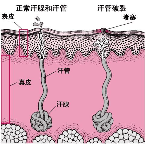 甘肃东大肛肠医院屁股总是起疮小心肛周化脓性汗腺炎