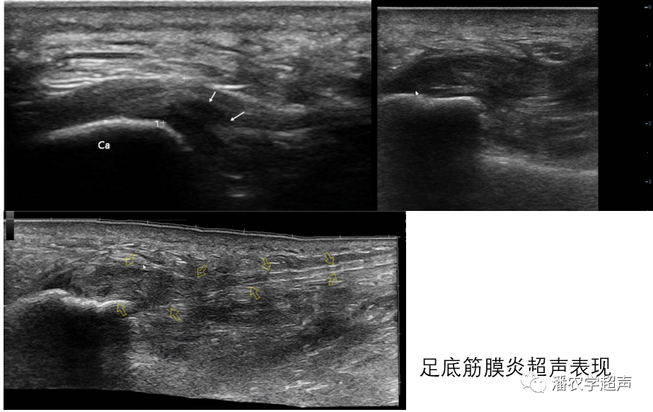 筋膜病变的超声检查