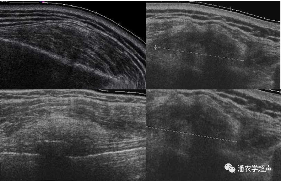 背部(肩胛下)弹力纤维瘤超声分型:i型为束状,回声不均匀.
