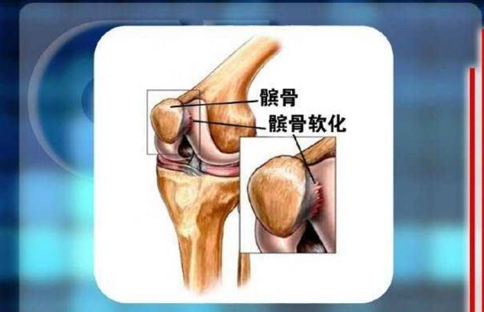髌骨软化症怎么康复最有效
