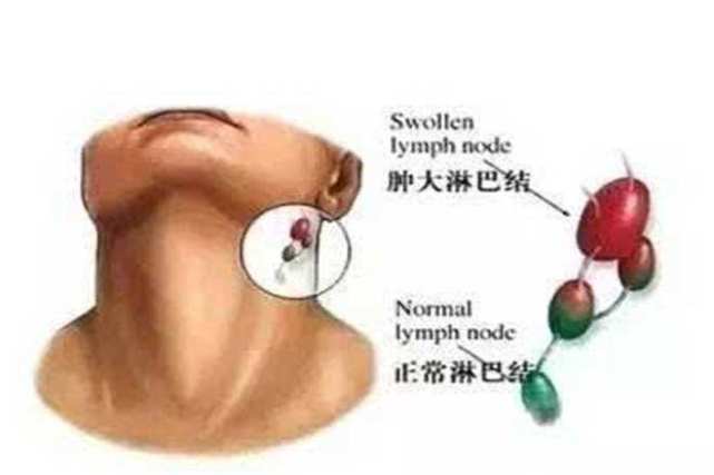 发现淋巴结肿大应该怎么办?_腾讯网