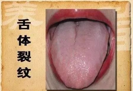 伸出舌头看看有这3种现象的要注意了当心癌症来敲门