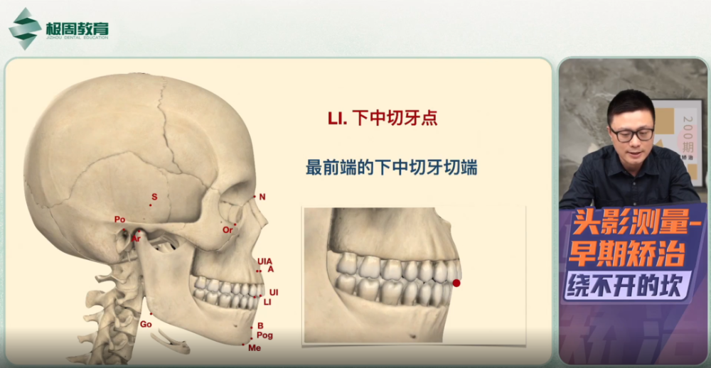 下唇突点pog"(pos):软组织颏前点分析项目主要看骨头的位置关系sna角