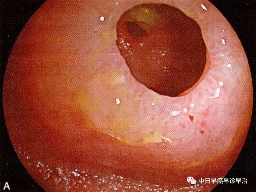 cmuse隐源性多灶性溃疡性狭窄性小肠炎