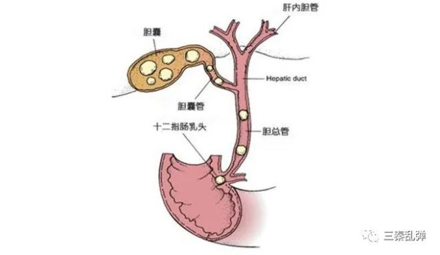 胆总管结石2.肝内胆管结石1.胆囊结石胆石症的分类