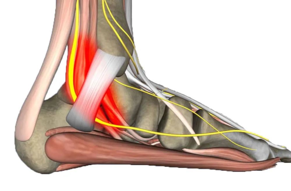 (metatarsal tunnel syndrome,也称胫后神经卡压综合征或踝管综合征