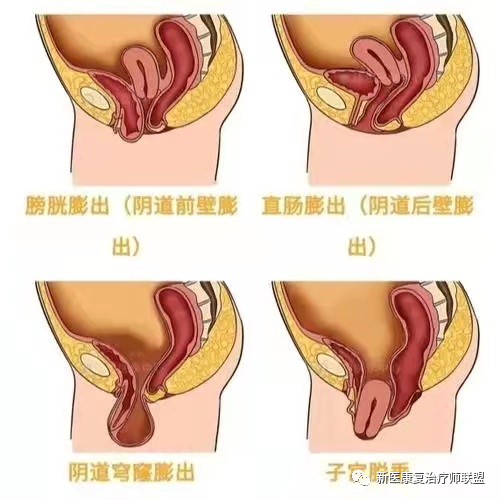 盆腔脏器(子宫,阴道前壁,阴道后壁)脱垂;1.