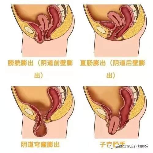 2.盆腔脏器(子宫,阴道前壁,阴道后壁)脱垂;1.