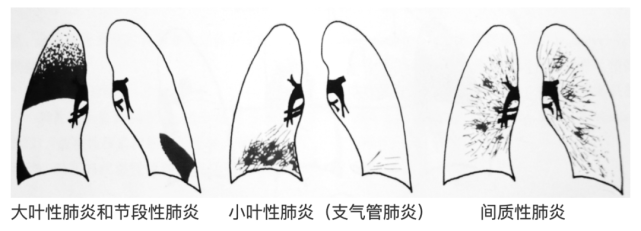 主任教学胸片怎么看肺炎如何判