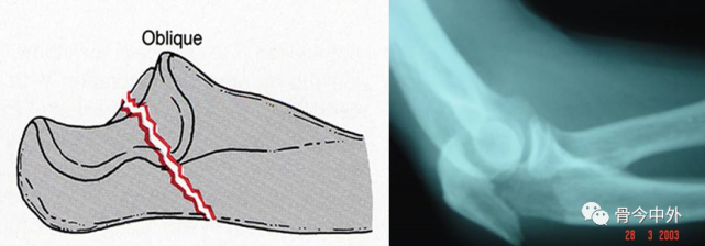 骨科小技巧尺骨鹰嘴骨折张力带固定